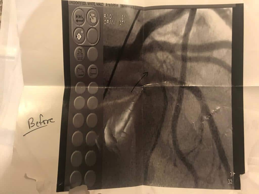 LDA Before Balloon Applied